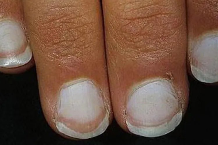得癌症人的指甲图片