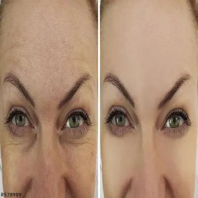 更年期综合征的治疗原则是什么