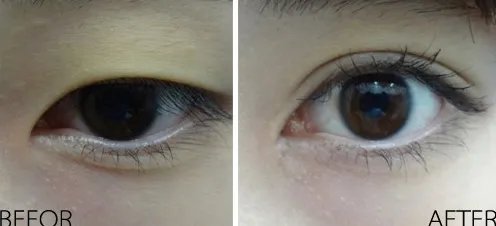 割双眼皮手术什么价格