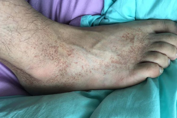 脚上有黑色素沉着图