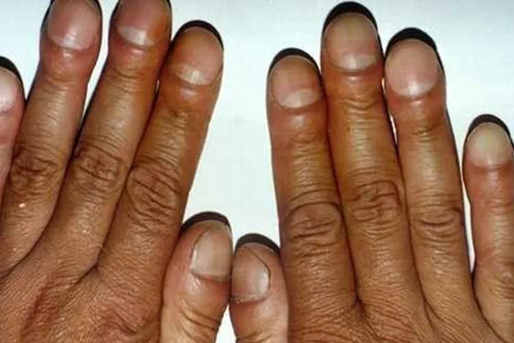 得癌症人的指甲图片