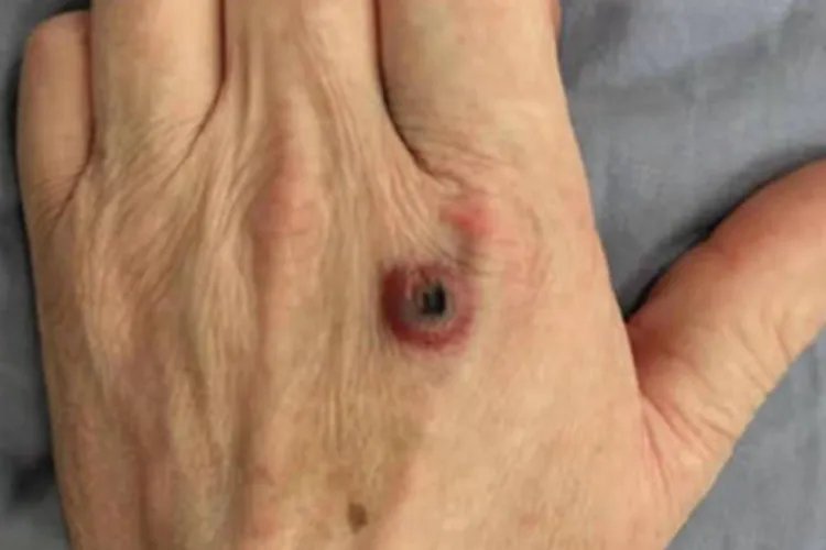 炭疽病皮肤红肿图片