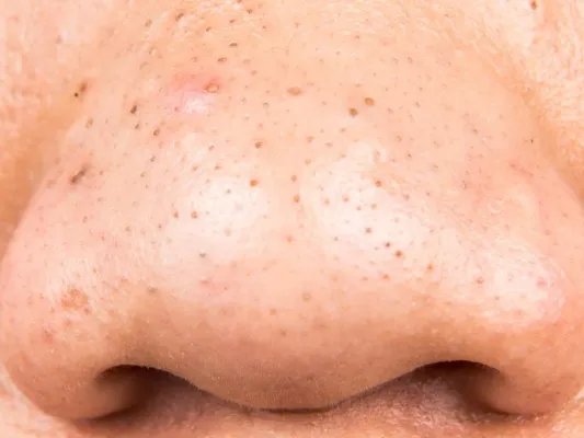 鼻子发干疼痛怎么回事