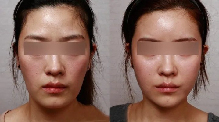 抽脂填充风险有哪些