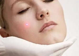 光子嫩肤适合人群