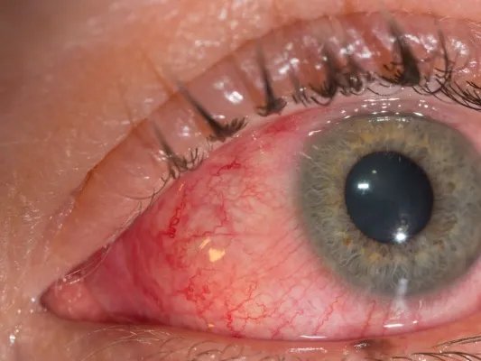 眼底病的治疗方法