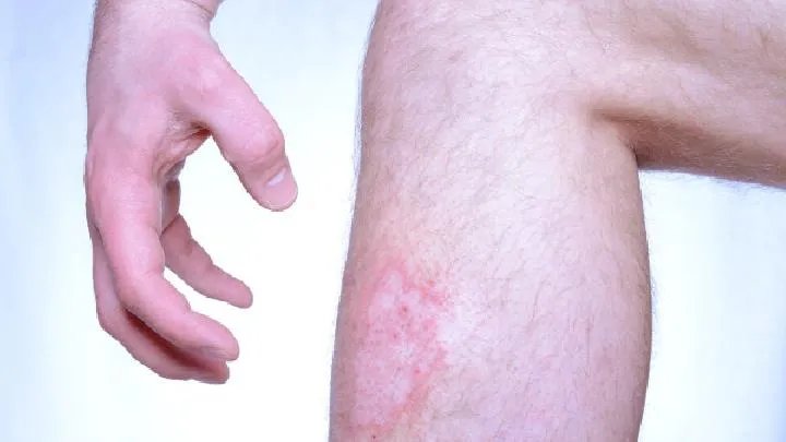 您知道牛皮癣该如何治疗吗?