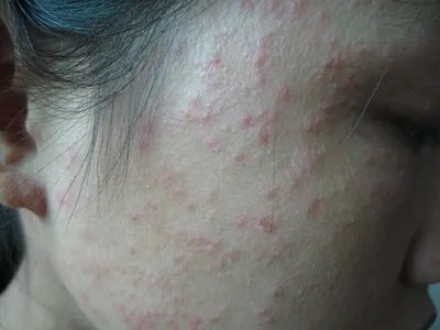 战壕热红点图片