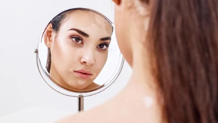 白癜风白斑是什么样的