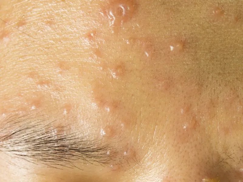 治疗痤疮的中药