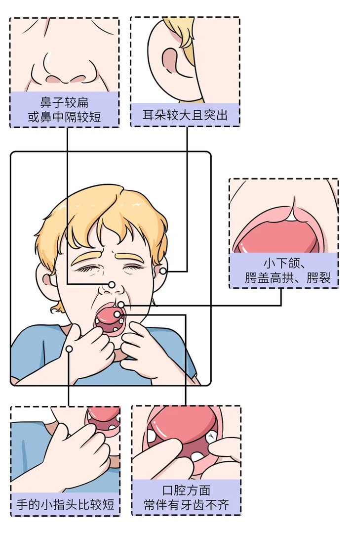长得太漂亮也是病？歌舞伎面谱综合征，一种美得像洋娃娃的遗传病