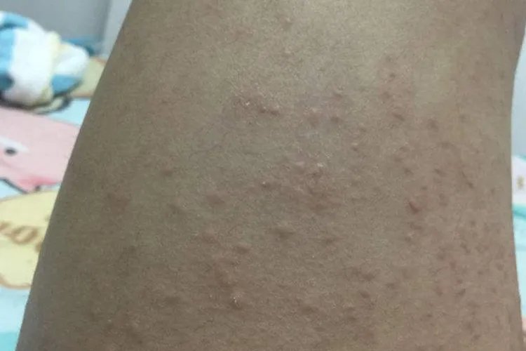 儿童湿疹的症状和图片