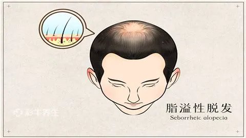 青少年脱发怎么办