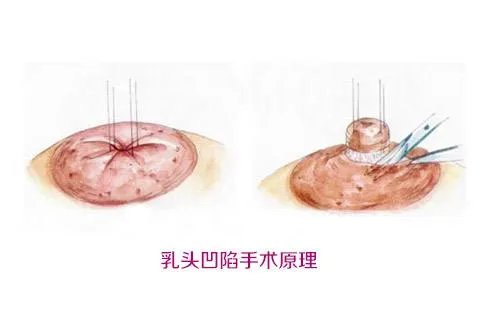 乳头内陷矫正术效果好吗