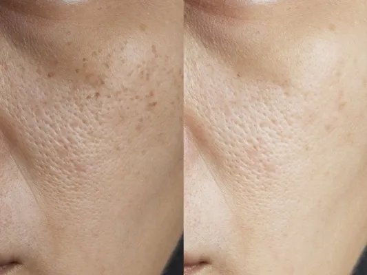 如何减少老年斑