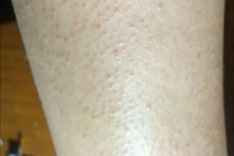 职业性毛发改变小疙瘩图片