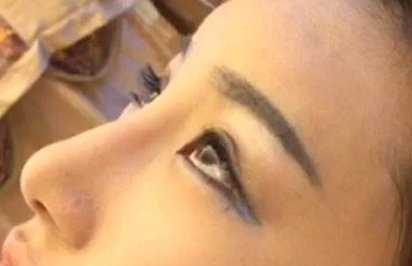 注射隆鼻后遗症