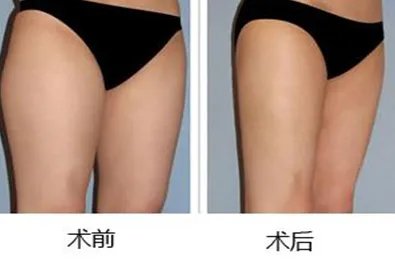 大腿抽脂价格