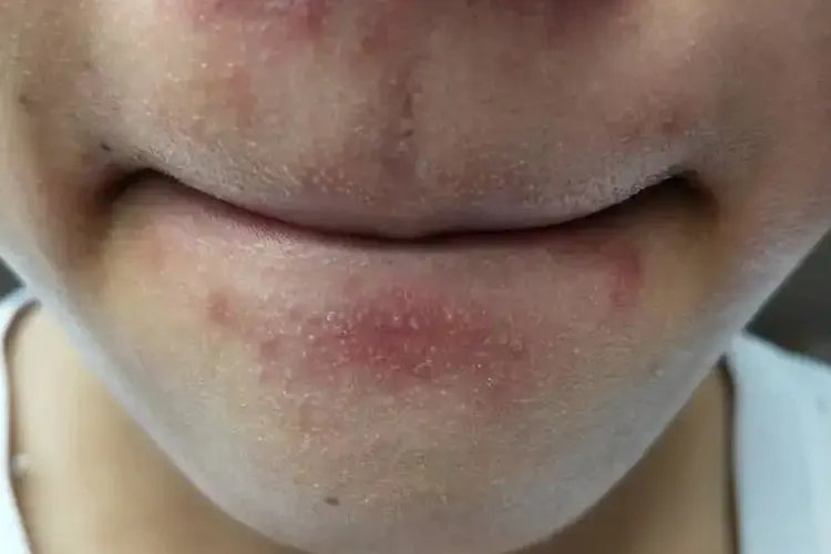 下巴和鼻子周围长小颗粒图片