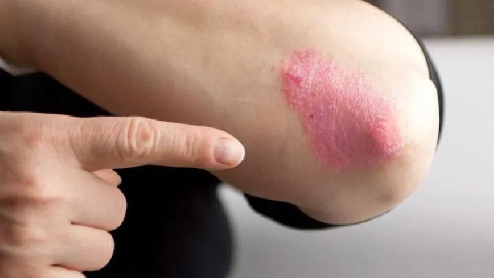 您知道牛皮癣该如何治疗吗?