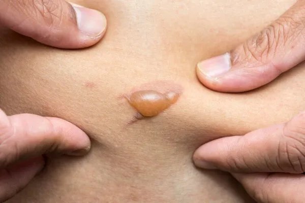 电热毯辐射大，不但杀精还会致癌？电热毯还能不能用？答案来了