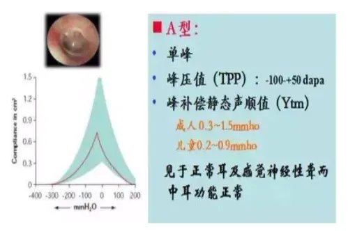 鼓室图a型什么意思