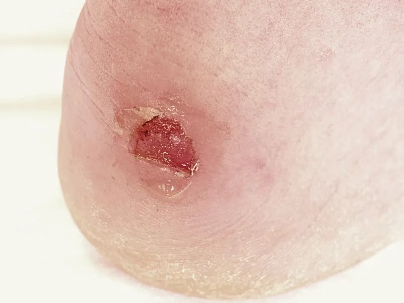 脚上长水泡很痒怎么办