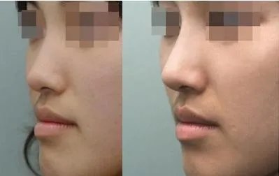 北京联合丽格第一医疗美容医院自体耳软骨隆鼻怎么样?价格一般多少钱