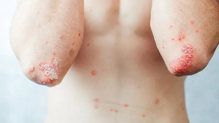 您知道牛皮癣该如何治疗吗?