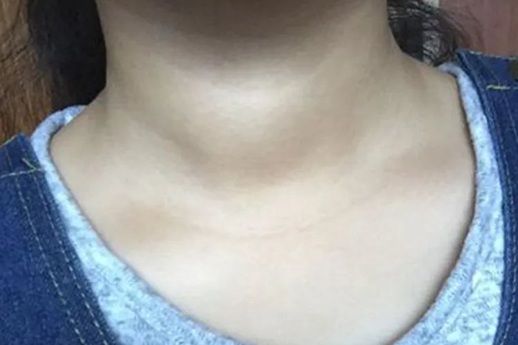 甲状腺喉结肿大图片