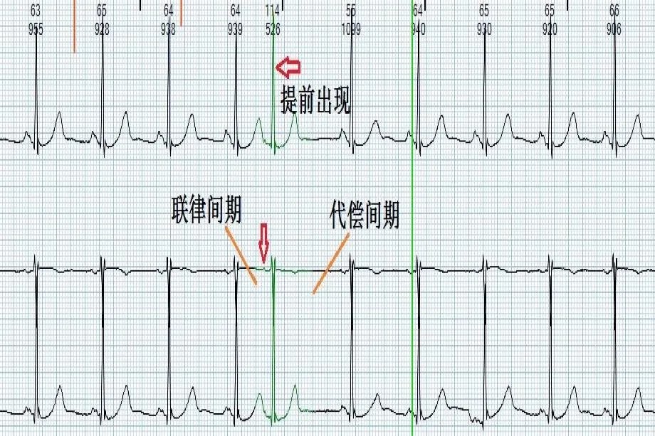 房性早搏心电图图片解析