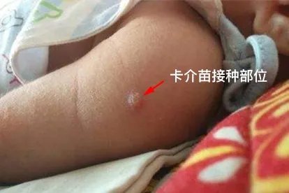 新生儿卡介苗接种部位图片